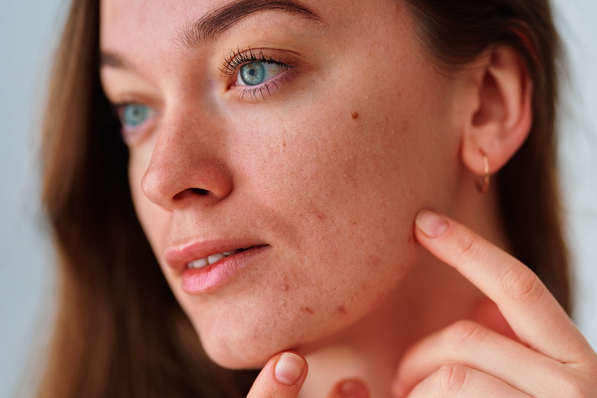 Close-up of a woman with sensitive skin showing acne and an impaired skin barrier