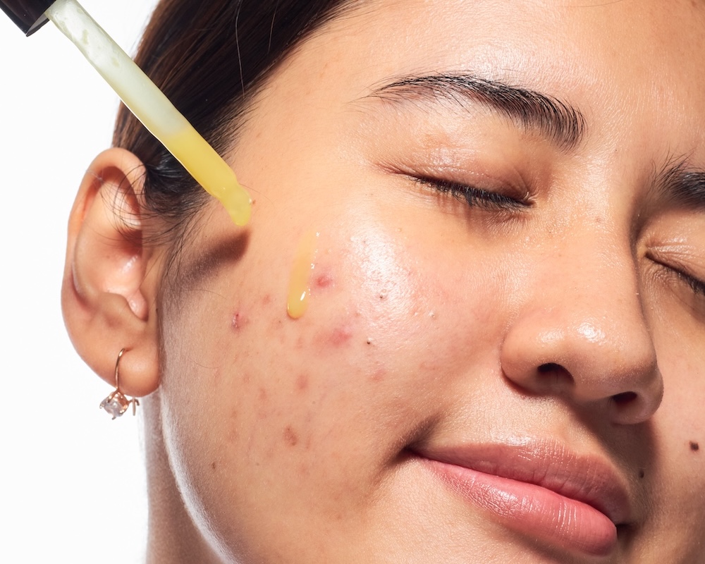 Woman applying serum to acne blemishes as part of a targeted skincare treatment