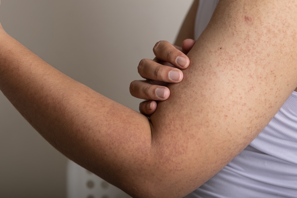Close-up of keratosis pilaris on a person’s arms showing small red bumps on the skin