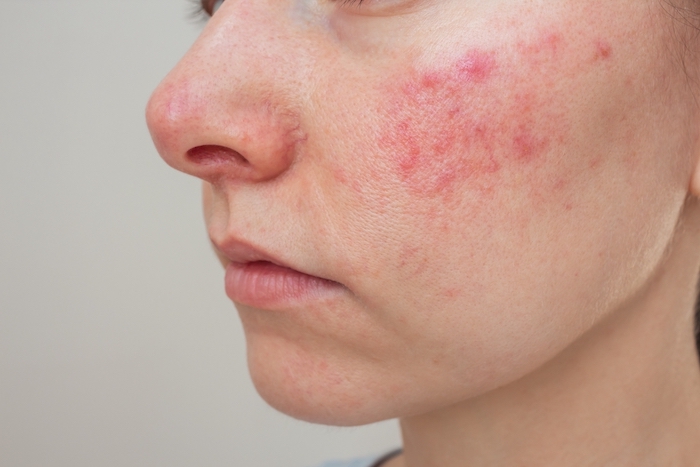 Woman with red, irritated skin