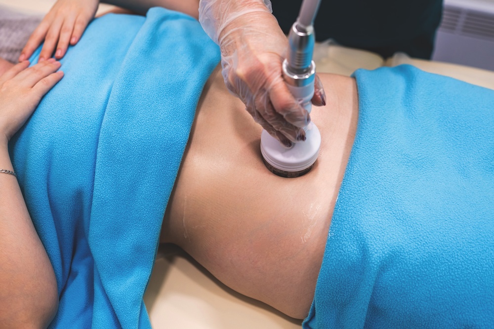 Client receiving a radiofrequency skin tightening treatment on the stomach to improve firmness after weight loss