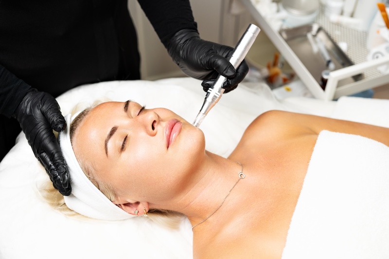 Client receiving a professional microneedling treatment at a beauty clinic