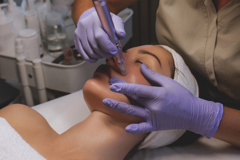 Young woman receiving microneedling treatment in a skin clinic as part of a preventative prejuvenation approach to stimulate collagen and improve skin texture