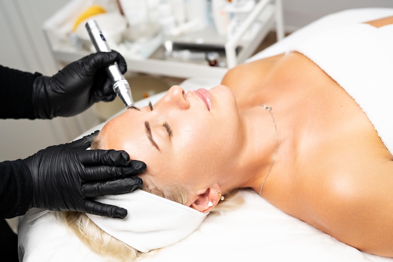 Client undergoing nanoneedling facial treatment performed by a skin therapist in a clinic setting