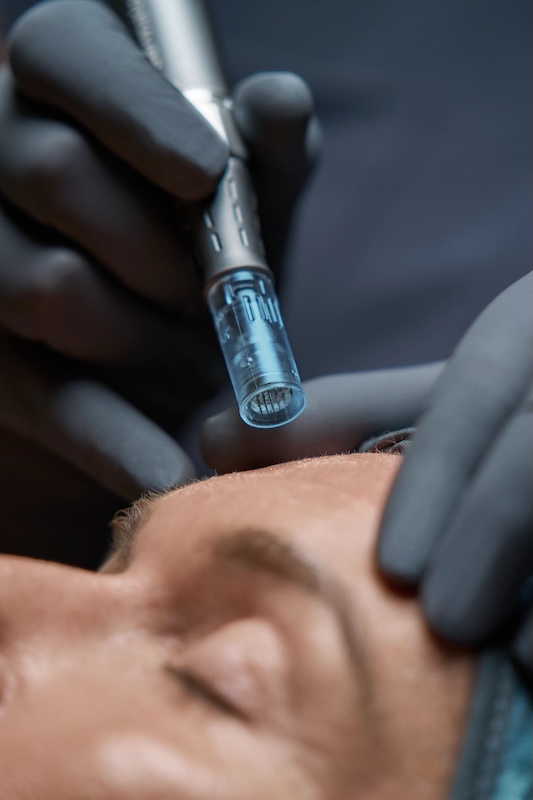 Dermalogica Pro Pen used during a Pro Microneedling treatment on a client