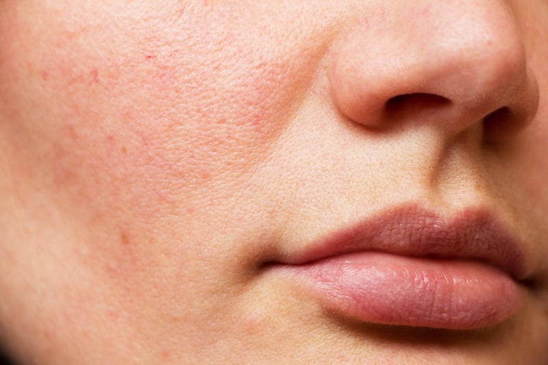 Close-up of a woman with visible facial redness across her cheeks